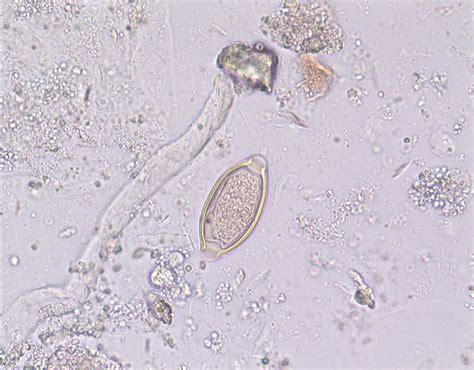 Trichuris Trichiura Ova