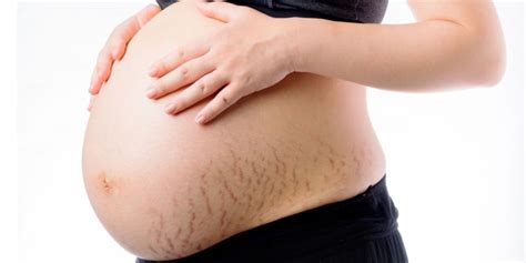 Stretch Marks During Pregnancy: Causes and How to Minimise the Lines