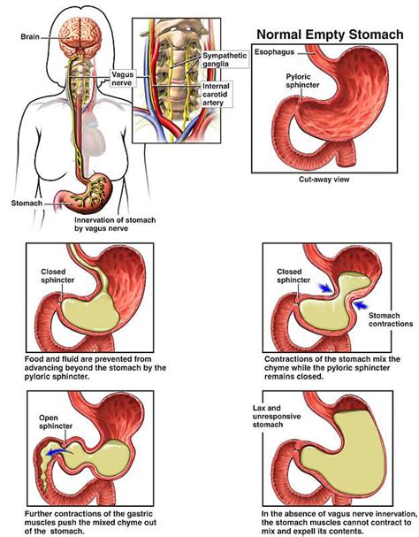 Help Gastroparesis | Symptoms | Gastroparesis treatment, Diabetes, What ...