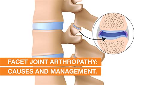 Facet Joint Arthropathy Treatment, Symptoms & Causes | QI Spine