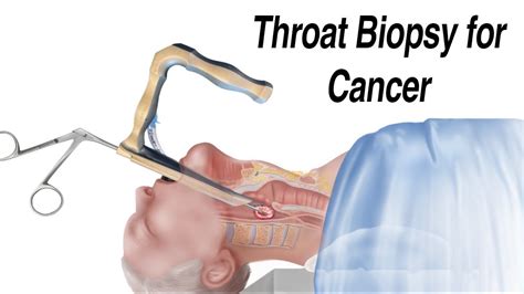 How a Throat Biopsy is Performed to Check for Throat Cancer - YouTube