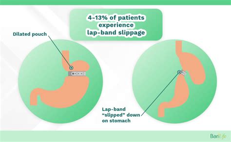 Lap band slippage: Symptoms, How to fix it and more