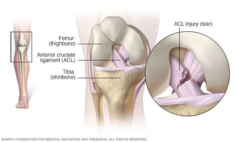 ACL injury - Symptoms and causes - Mayo Clinic