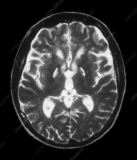 Anoxia brain damage, MRI scan - Stock Image - C004/1465 - Science Photo ...