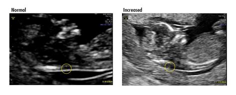 Increased Nuchal Translucency - Prenatal Screening Ontario