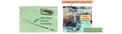 Esophageal pressure monitoring system combined with the esophageal ...