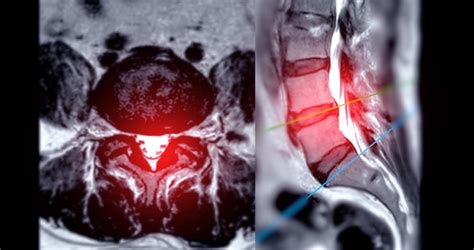 Compression Fracture Treatment - Advanced Pain Management Health Publishing