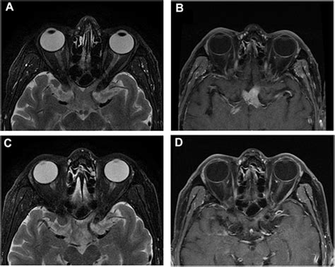 Frontiers | Orbital Magnetic Resonance Imaging May Contribute to the ...