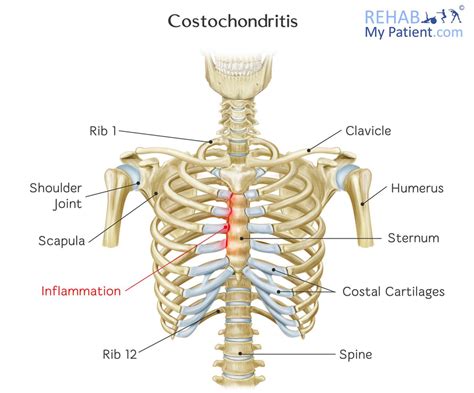 Costochondritis | Rehab My Patient