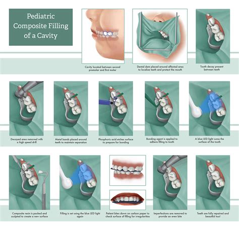 Composite Cavity Filling on Behance