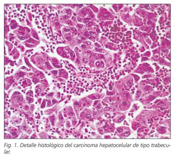 CARCINOMA HEPATOCELULAR HISTOLOGIA PDF