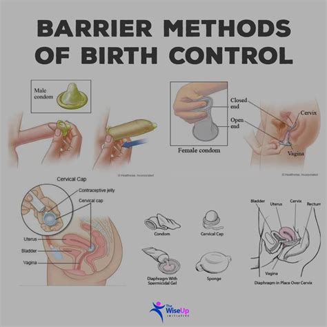 Barrier Methods of Contraception | Viquepedia