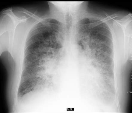 Pulmonary edema | Radiology Reference Article | Radiopaedia.org