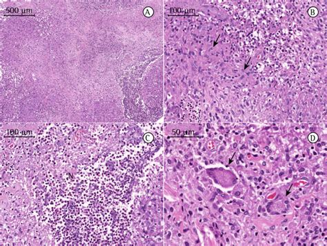 -Photomicrographs of a cervical lymph node biopsy sample. Lymphoid ...