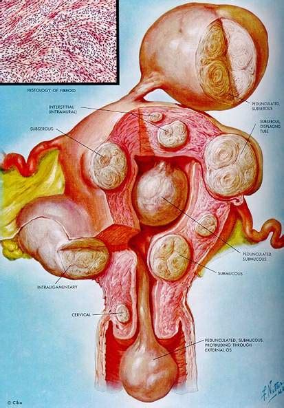 Myomectomy – VBGYN.com