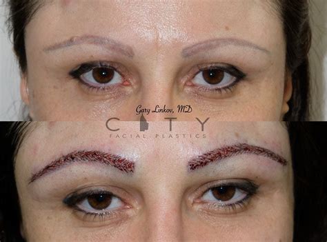 NYC Eyebrow Restoration | New York Eyebrow Hair Transplant | UES