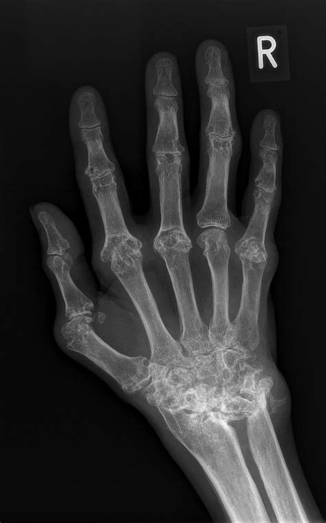 Rheumatoid Arthritis X Ray : Normal vs. Arthritic Joints : What happens ...