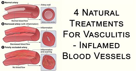 Vasculitis Symptoms