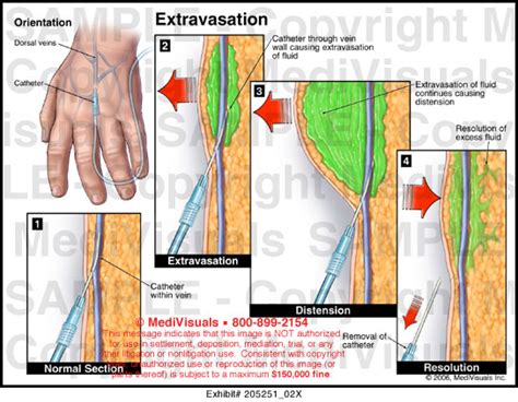 Extravasation Medical Illustration Medivisuals