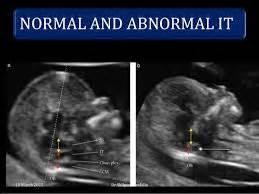 Abnormal Nuchal Translucency Ultrasound