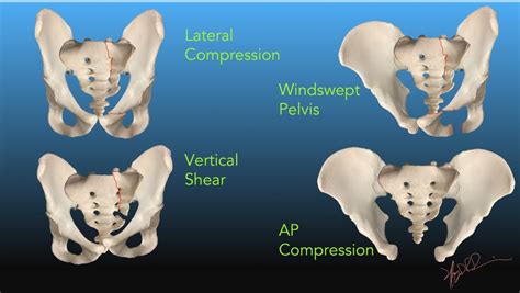 Pelvic Fractures | UW Emergency Radiology