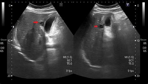 Figure 3 from Gallbladder perforation - radiological aspects, types and ...