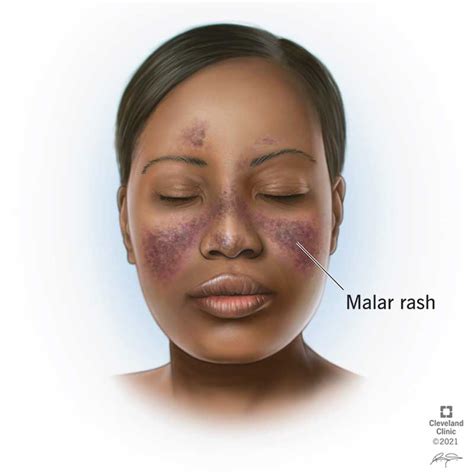 Lupus Rash: Types, Causes, Treatment & Prevention