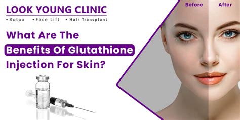 What Are The Benefits Of Glutathione Injection For Skin?