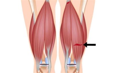 Hamstring Strain Rehabilitation Exercises | Sports Injury Rehabilitation