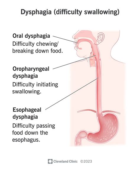 Dysphagia (Difficulty Swallowing): What It Is, Causes & Treatment