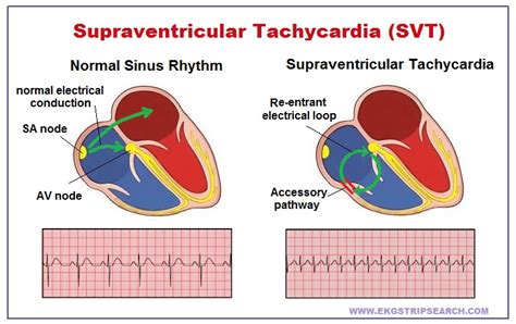 What Is Supraventricular Tachycardia Svt Svt Heart Cardiac Images And ...