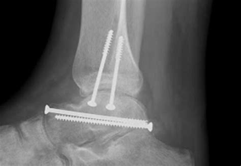 Talus Fractures - Dr Warren