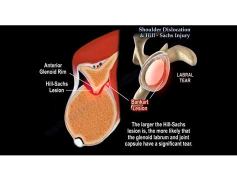 Shoulder Dislocation and Hill Sach’s Lesion — OrthopaedicPrinciples.com