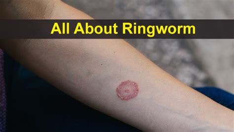 All About Ringworm: Causes, Symptoms, Risk Factors, Diagnosis ...