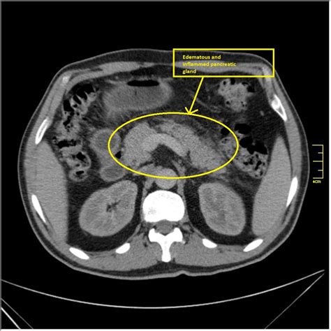 Acute pancreatitis CT - wikidoc