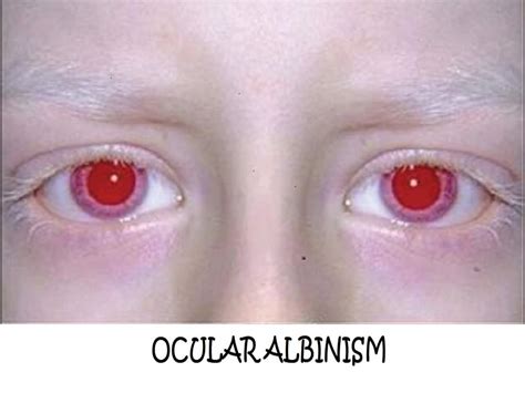 International Albinism Awareness Day: Symptoms Of Ocular Albinism And ...