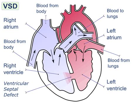 VSD - Ventricular Septal Defect - almostadoctor