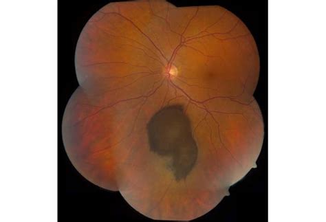 Choroidal Melanoma | Wills Eye Hospital