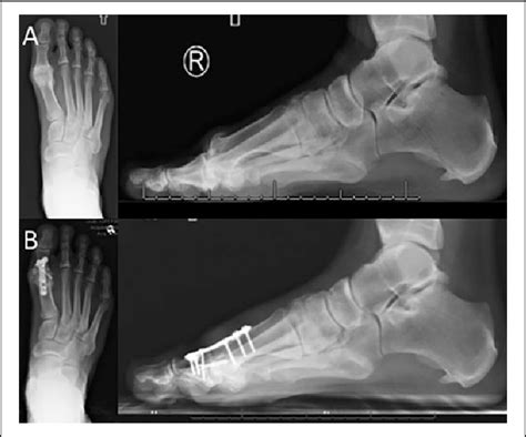 First metatarsophalangeal joint arthrodesis. (A) Significant sclerosis ...