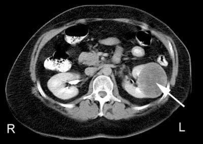 Left-sided flank pain | MDedge Family Medicine