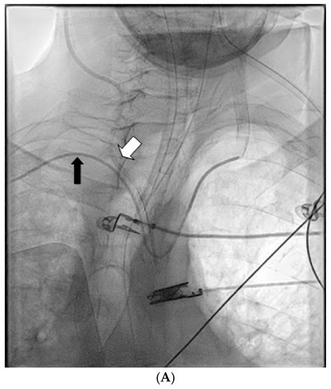 JPM | Free Full-Text | Management of Inadvertent Arterial ...