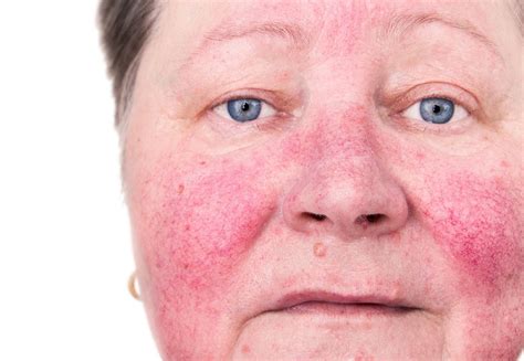 Rosacea - Symptoms, Causes, Treatment and Photos