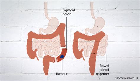 Bowel Cancer Surgery, Complications & Recovery