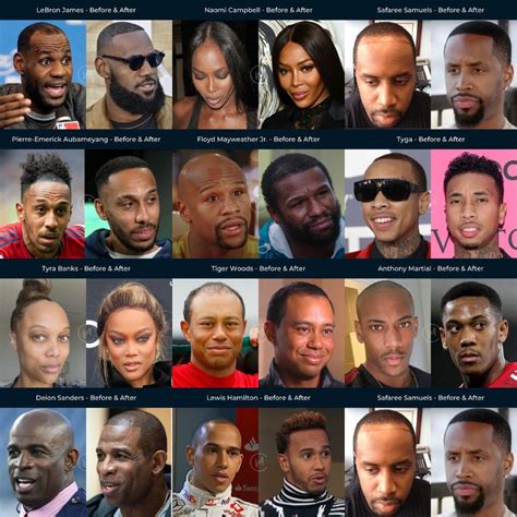 21 Black Celebrity Hair Transplants - Before & After Photos