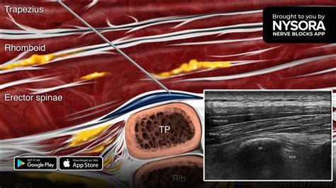 Tips for the Erector Spinae Plane Block - NYSORA