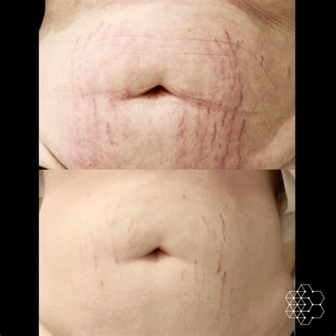 Let's Talk About Laser Stretch Mark Removal Treatment | Skin Technique