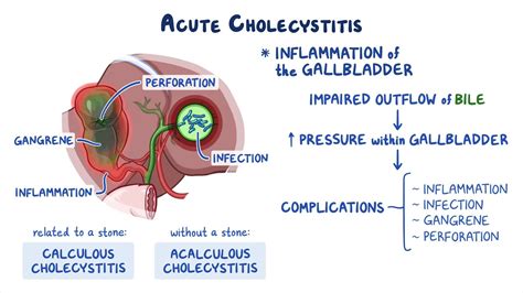 Cholecystitis: Clinical sciences - Osmosis Video Library