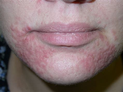 Mild Perioral Dermatitis