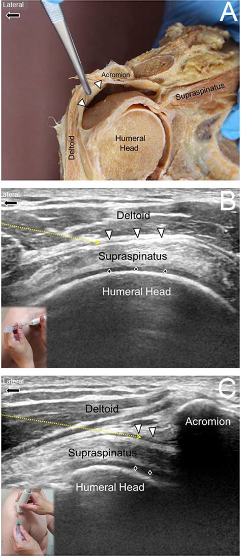 Subdeltoid Bursitis