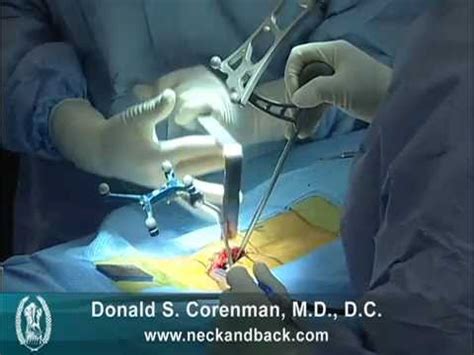 L5 S1 Fusion | TLIF Back Surgery Video | O Arm CT| Vail Colorado - YouTube